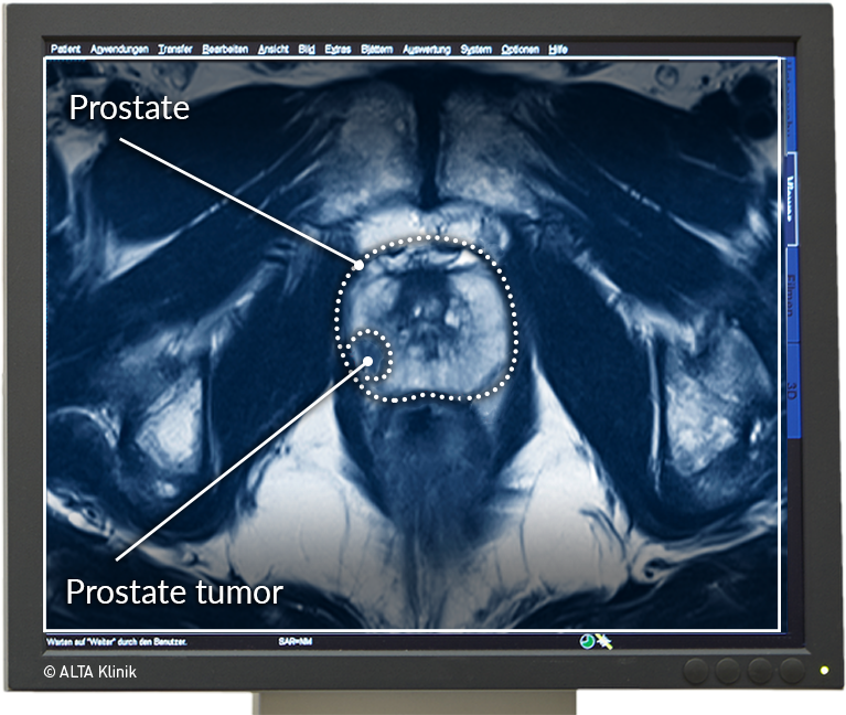 Multiparametric Mri Of The Prostate Alta Klinik