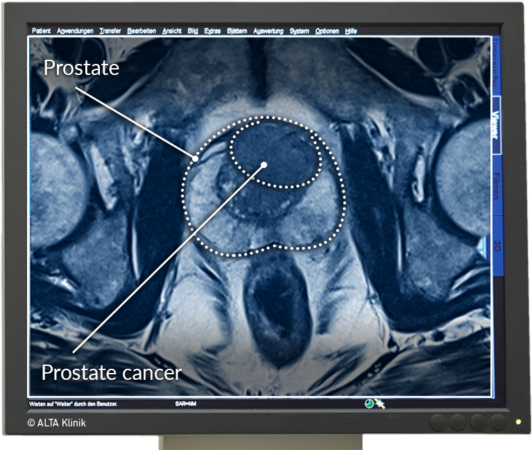 Prostate Mri Image Labeled