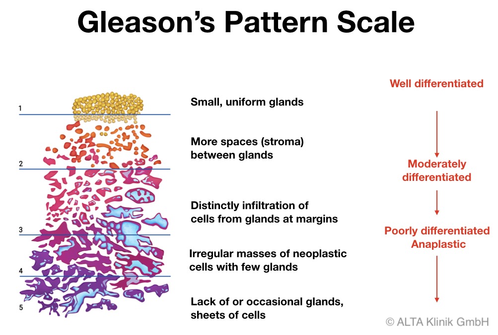 gleason-score-alta-klinik